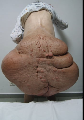 Before Image: Neurofibromatosis Case Study 13 – Surgical Planning - back