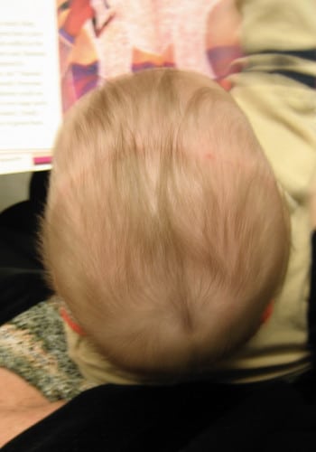 After Image: Craniosynostosis - back