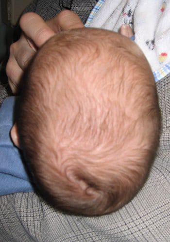 Before Image: Craniosynostosis - back