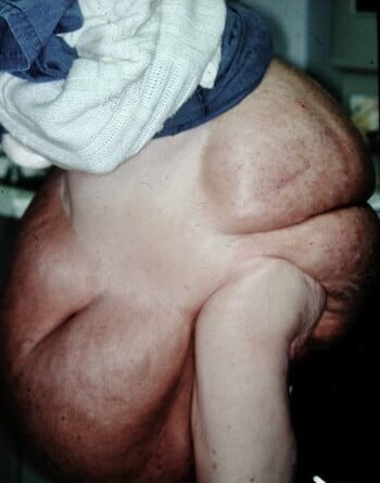Before Image: Neurofibromatosis Case Study 12 – Corrective Surgery Review - left-side