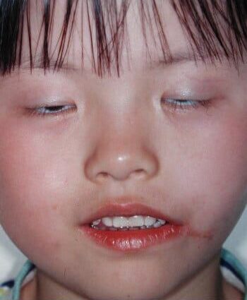 After Image: Facial Cleft - front