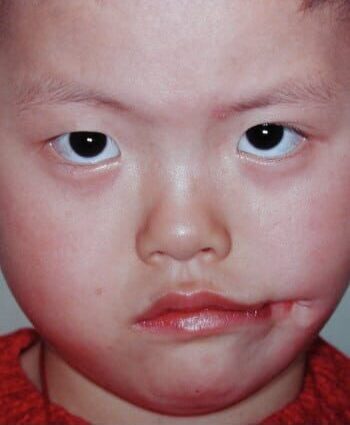 Before Image: Facial Cleft - front