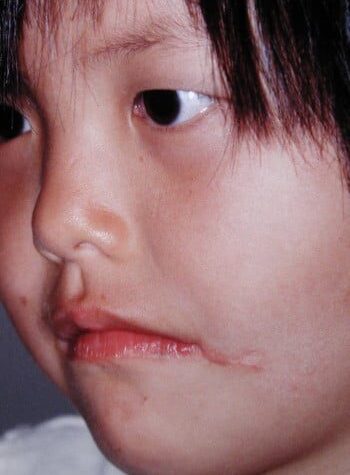 After Image: Facial Cleft - left-front-oblique