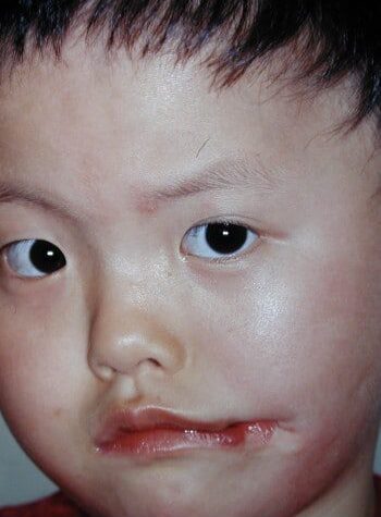 Before Image: Facial Cleft - left-front-oblique