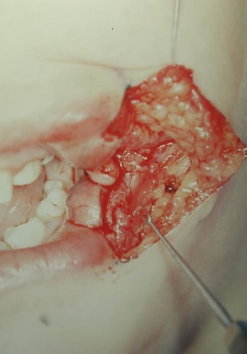 After Image: Facial Cleft - left-front-oblique