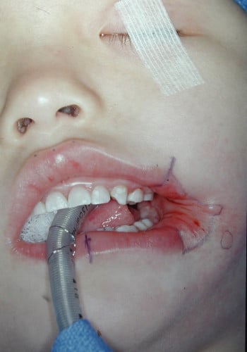 Before Image: Facial Cleft - left-front-oblique