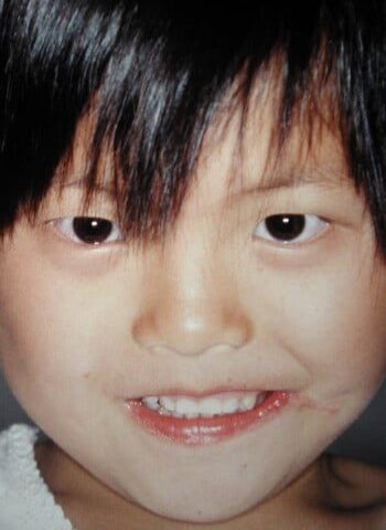 After Image: Facial Cleft - front