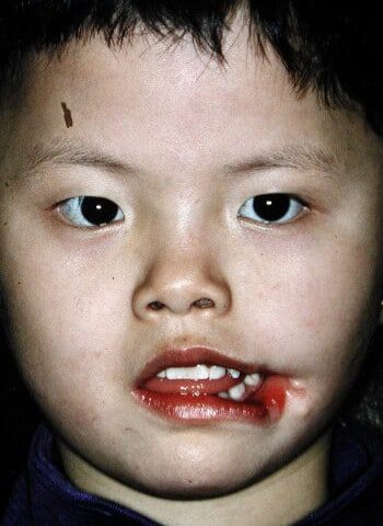 Before Image: Facial Cleft - front
