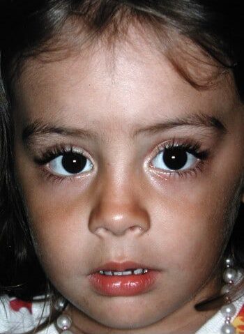After Image: Craniosynostosis - front