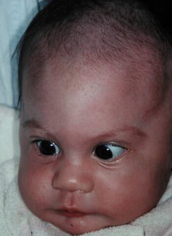 Before Image: Craniosynostosis - front