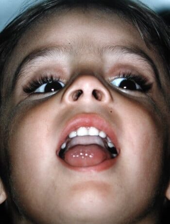 After Image: Craniosynostosis - other