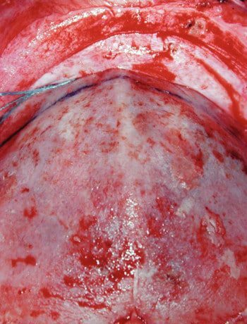 Before Image: Craniosynostosis - other