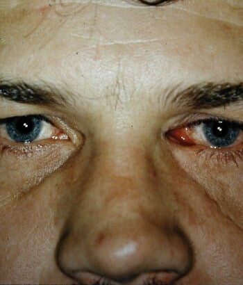After Image: Facial Fractures - front