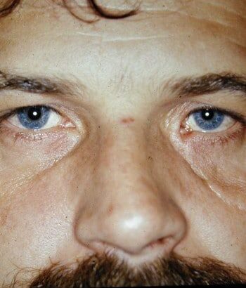 Before Image: Facial Fractures - front