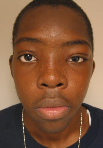 After Image: Craniofacial Tumor (Mucocele) - front