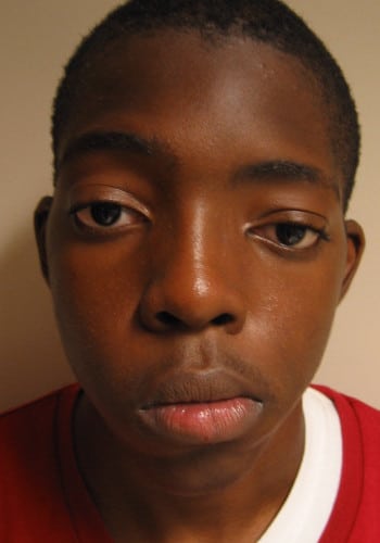 Before Image: Craniofacial Tumor (Mucocele) - front