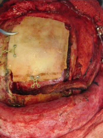 After Image: Craniofacial Tumor (Mucocele) - front