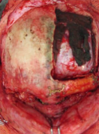 Before Image: Craniofacial Tumor (Mucocele) - front