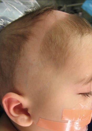 After Image: Craniosynostosis - other