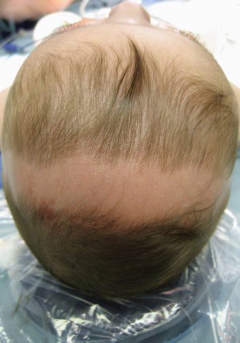 Before Image: Craniosynostosis - other