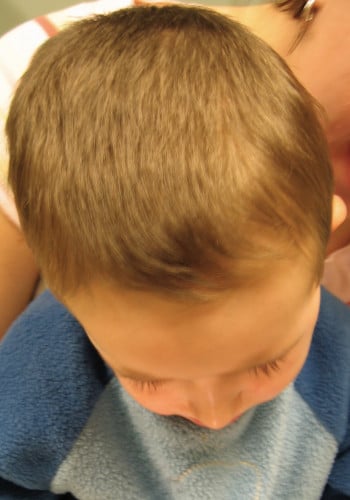 After Image: Craniosynostosis - other
