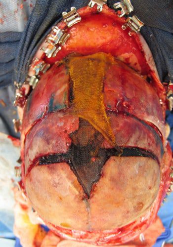 Before Image: Craniosynostosis - other