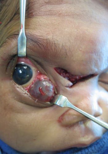 After Image: Encephalocele - right-front-oblique