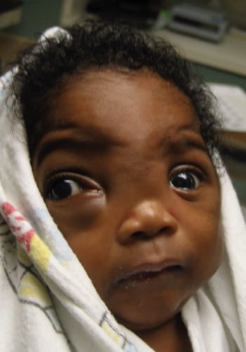 Before Image: Encephalocele - right-front-oblique