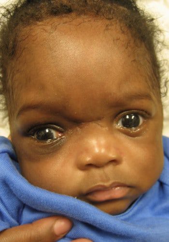 After Image: Encephalocele - front