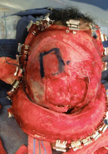 Before Image: Encephalocele - front
