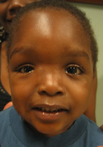 After Image: Encephalocele - front