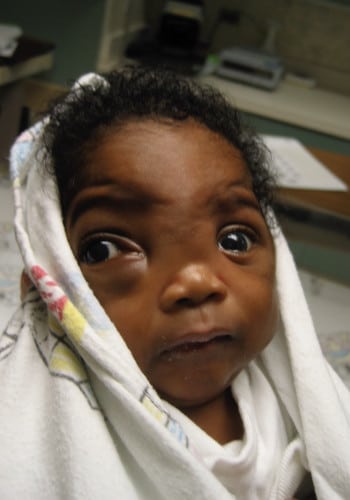 Before Image: Encephalocele - front