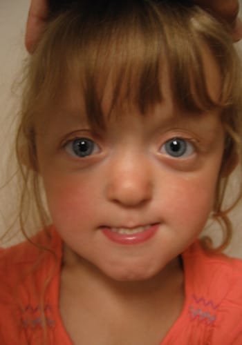 After Image: Craniosynostosis - front