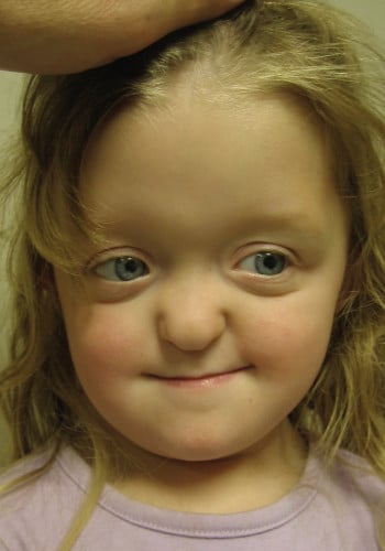 Before Image: Craniosynostosis - front