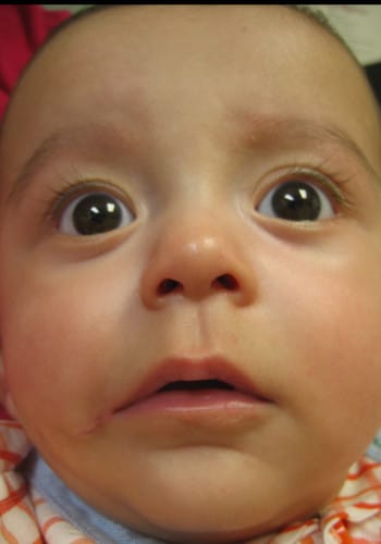 After Image: Facial Cleft - front