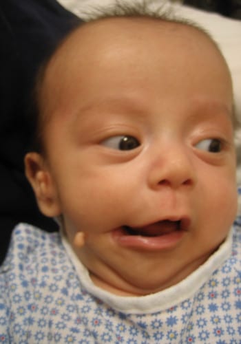 Before Image: Facial Cleft - front