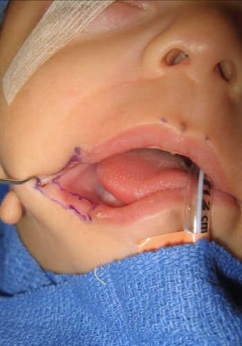 After Image: Facial Cleft - front