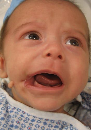 Before Image: Facial Cleft - front