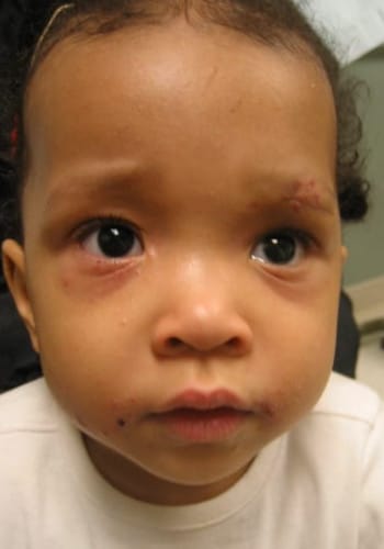 After Image: Venous Malformation - front