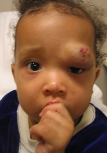 Before Image: Venous Malformation - front
