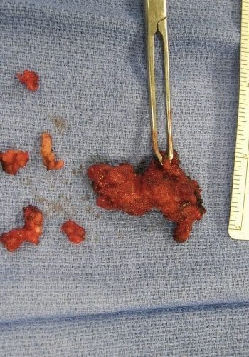 After Image: Venous Malformation - front