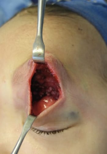 Before Image: Venous Malformation - front