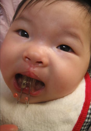 After Image: Cleft Lip - front