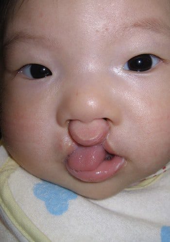Before Image: Cleft Lip - front