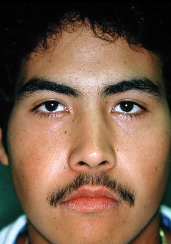 After Image: Craniofacial Tumor (Fibrous Dysplasia) - front
