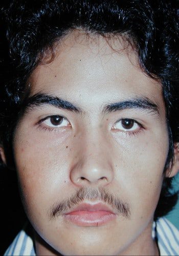 Before Image: Craniofacial Tumor (Fibrous Dysplasia) - front