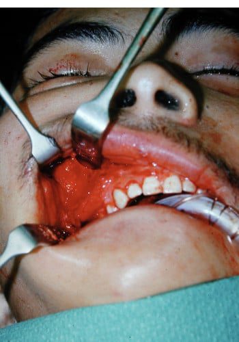 After Image: Craniofacial Tumor (Fibrous Dysplasia) - front