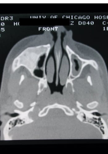 Before Image: Craniofacial Tumor (Fibrous Dysplasia) - front