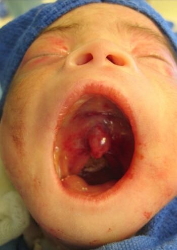 After Image: Craniofacial Tumor (Teratoma) - front