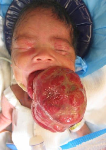 Before Image: Craniofacial Tumor (Teratoma) - front